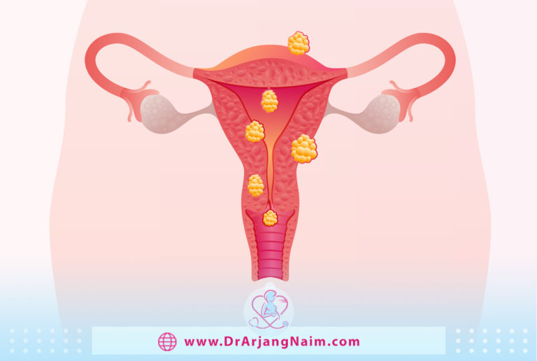 uterine fibroid pain