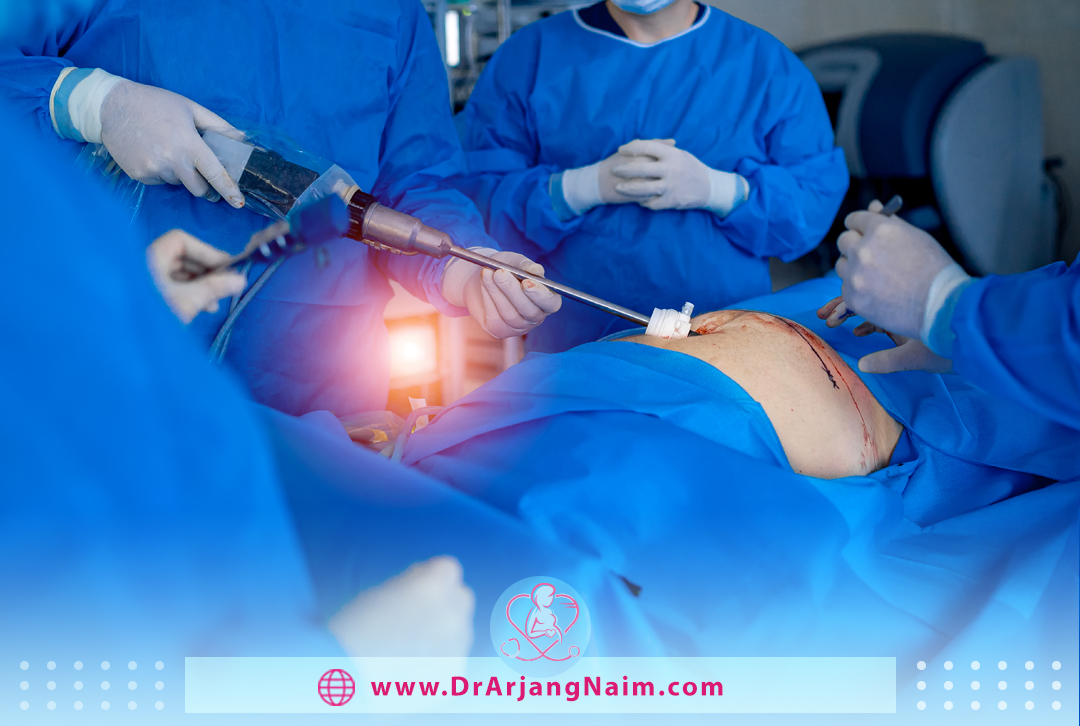 abdominal laparoscopy 