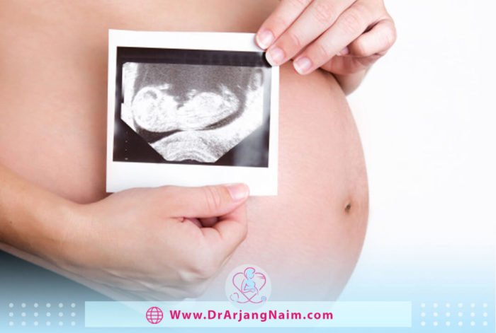 Can you have a healthy baby with Polyhydramnios