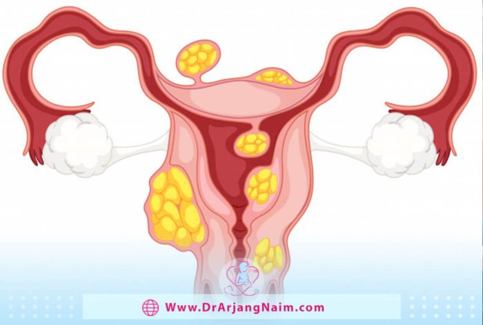 How Do Uterine Fibroids Affect Pregnancy and Fertility