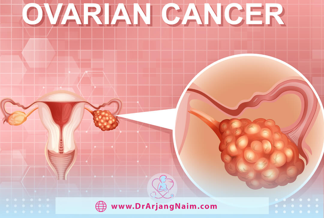 Ovarian Cancer