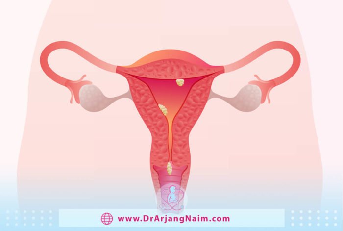 What are uterine Polyps