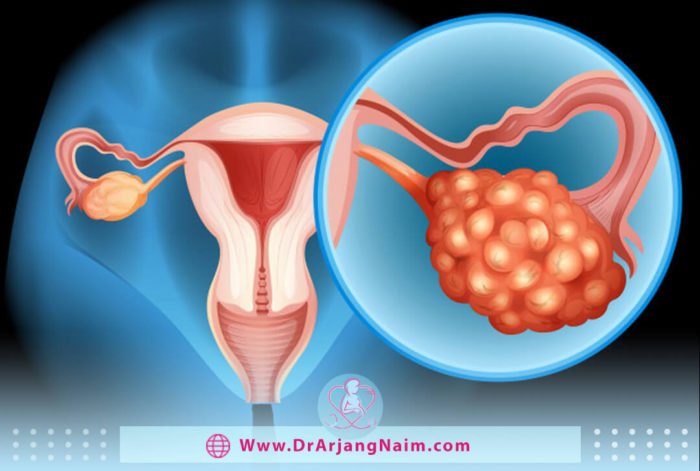 What causes ovarian cancer