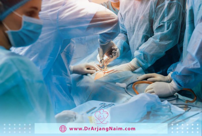 What is myomectomy surgery