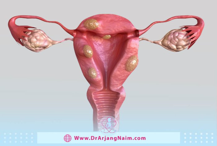 fibroid