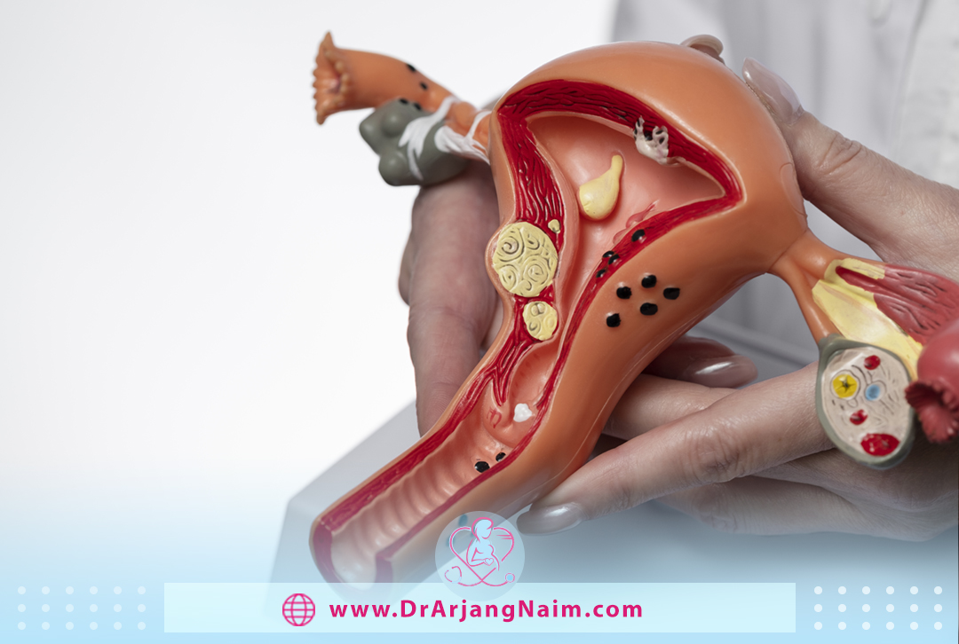 What is Uterine Sarcoma?